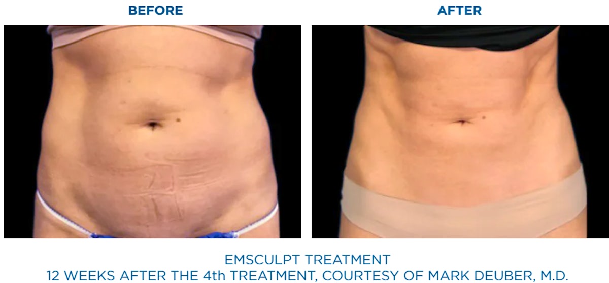 shape and contour body