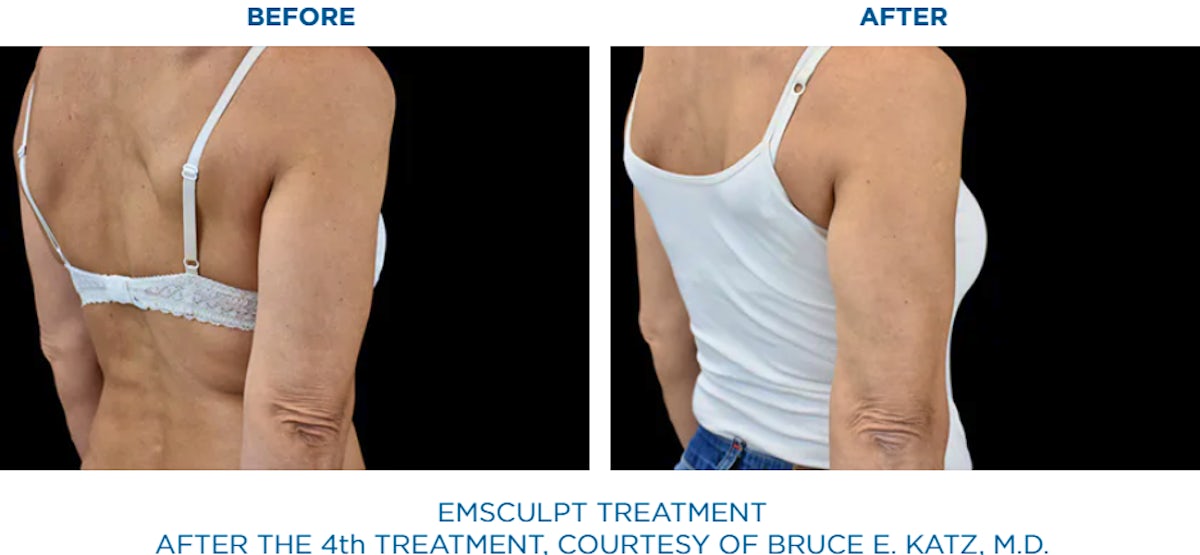 shape and contour body