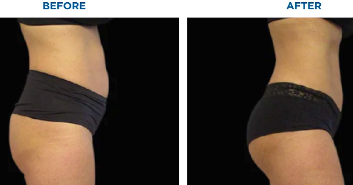 shape and contour body