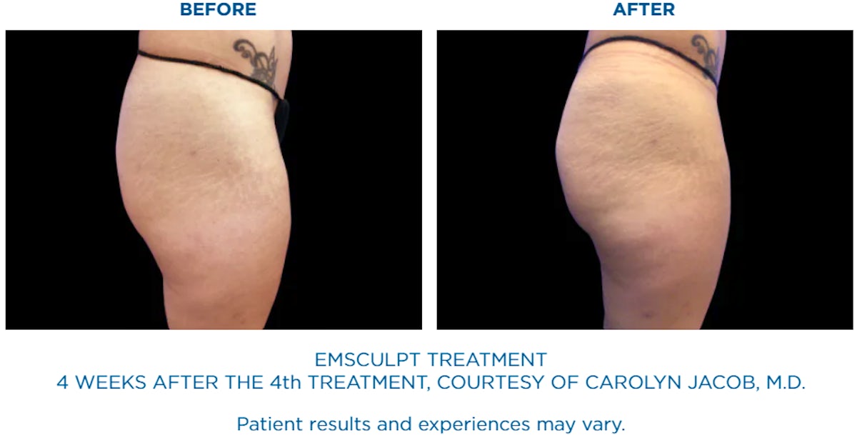 shape and contour body